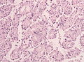 Papillary meningiomao with discohesive meningothelial tumour cells around a fibrovascular core