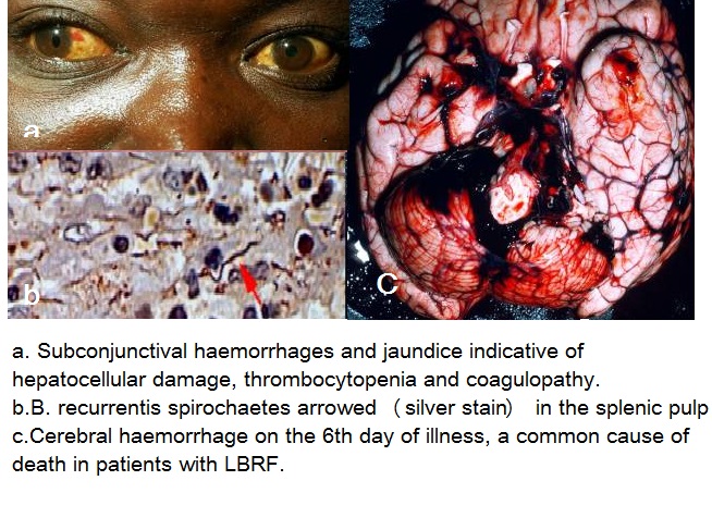 File:Pathophysiology LBRF.jpg