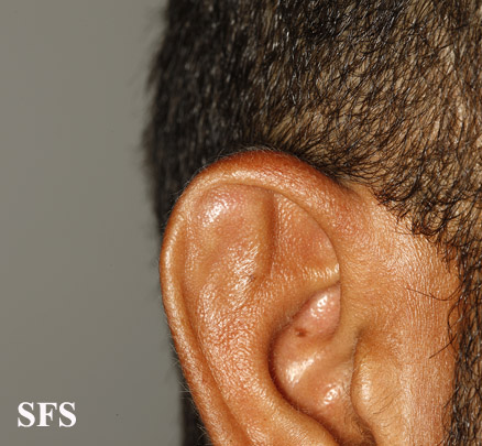Pseudocyst of ear. Adapted from Dermatology Atlas.[6]