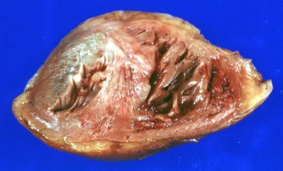 Myocardial Infarct: Gross natural color apical section showing large left ventricle infarct and right ventricular hypertrophy