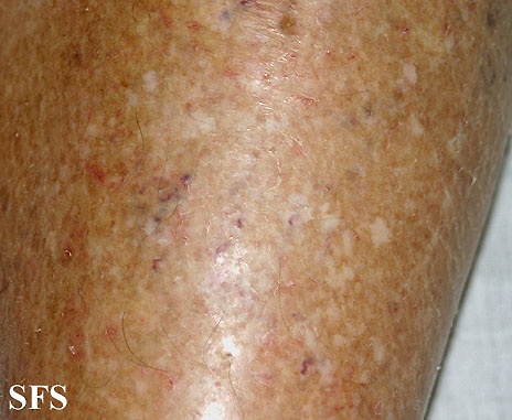 Xerotic eczema Adapted from Dermatology Atlas.<ref name="Dermatology Atlas">{{Cite