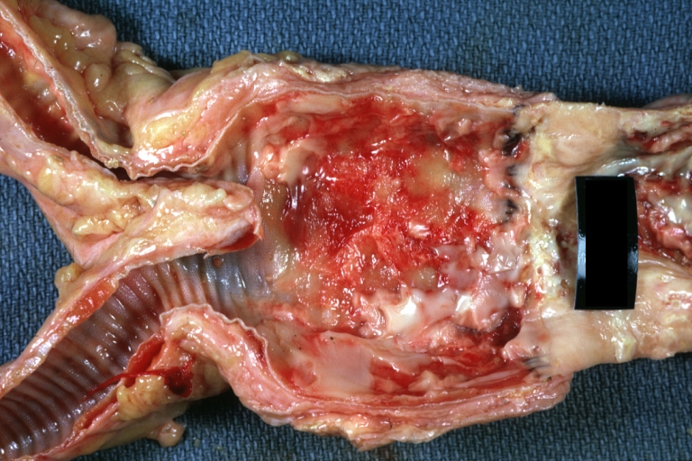 Abdominal Aneurysm Graft Repair: Gross, natural color, close-up view, an excellent example of Dacron graft that has been in place for years with pseudointima and atherosclerosis