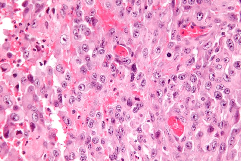 Very high magnification micrograph of epithelioid sarcoma<ref> Epithelioid sarcoma librepathology
