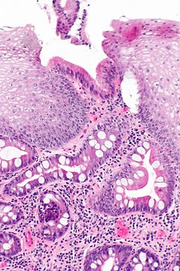 File:Esophagus with intestinal metaplasia -- intermed mag.jpg