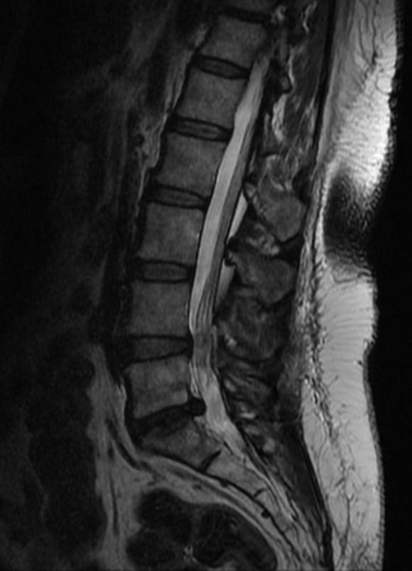 File:Intraspinal synovial cyst 001.jpg