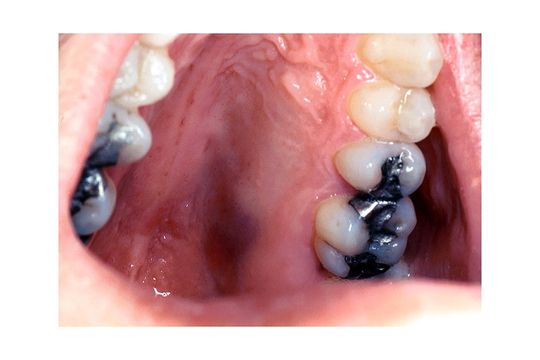 Kaposi's sarcoma oral 001.jpg