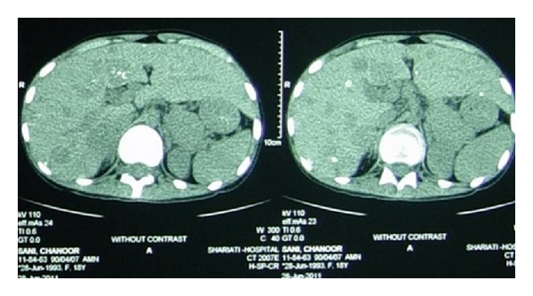 Spiral abdominopelvic CT scan (with contrast). The report was as follows. Multiple calcified and noncalcified lesions in liver are seen (metastasis should be considered). Some of the small bowel loops have thickened wall. Mild right side hydronephrosis is present. Anterior abdominal wall fistula is depicted. A few small paraaortic lymphnodes are seen. Mild left side pleural effusion and massive ascites were also noted.[9]