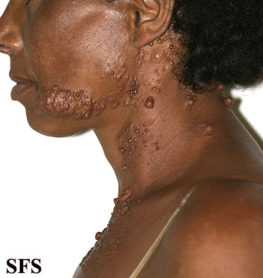 Segmental neurofibromatosis. With permission from Dermatology Atlas.[3]
