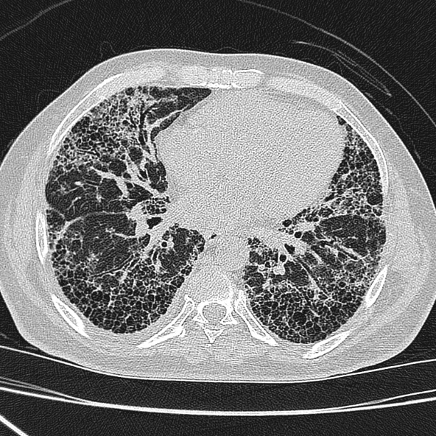 File:Usual-interstitial-pneumonia-uip-2.jpg