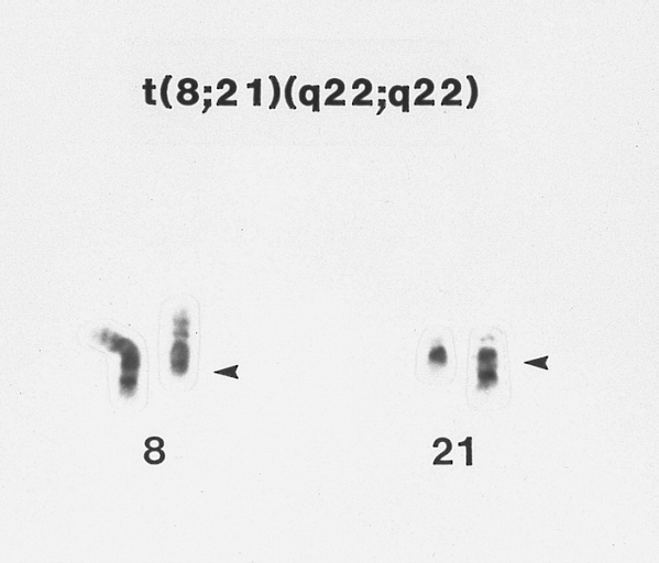 Acute myeloblastic leukemia with maturation (AML-M2) associated with A t(8;21) chromosome abnormality G-banded Wright-Giemsa stained partial karyotype showing the 8;21 chromosome translocation. The abnormal chromosomes are on the right, with breakpoints designated by arrowheads.