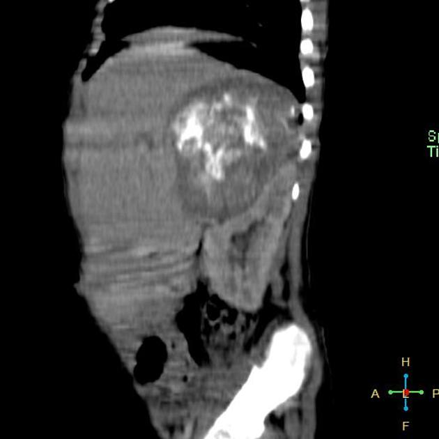 Neuroblastoma observed as a right suprarenal mass with an abundant calcification on sagittal CT scan[3]