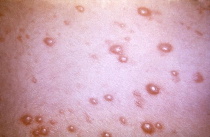 Pustulovesicular rash represents a generalized herpes outbreak due to the Varicella-zoster virus (VZV) pathogen. From Public Health Image Library (PHIL). [1]