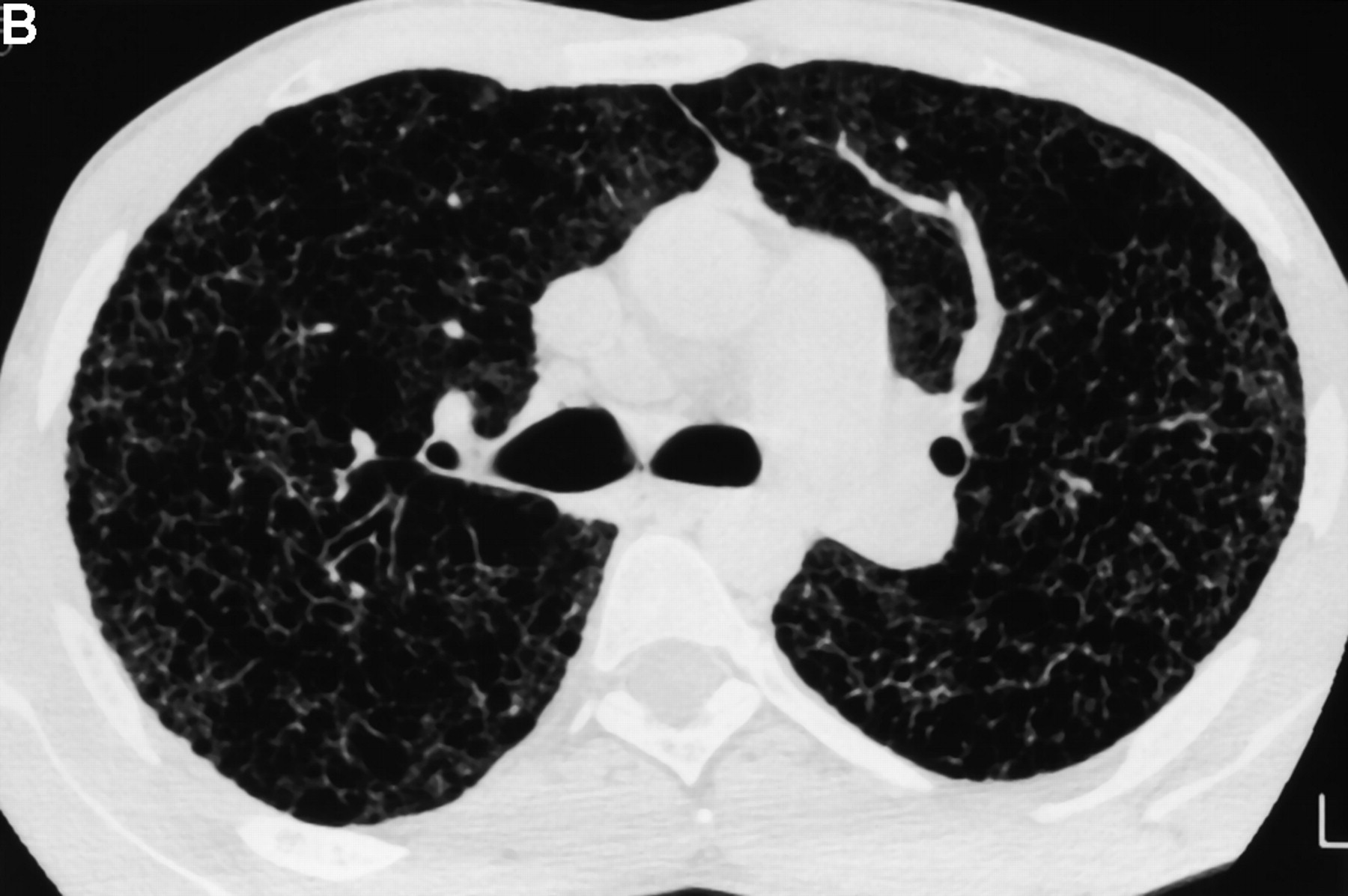 CT-scan for a patient with advanced histiocytosis X associated with severe pulmonary hypertension.