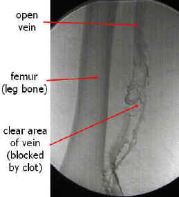 A venographic image of a deep vein thrombosis. Source: www.lakeridgehealth.on.ca