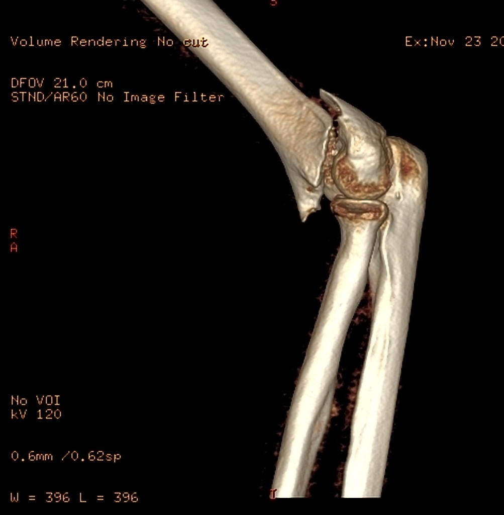 Comminuted T- condylar fracture of the left distal humerus is noted with intra-articular extension. Posterior displacement of the distal fragment is seen in the sagittal plane; with mild lateral/valgus displacement and rotation is noted in the coronal plane. No radial or ulnar fracture is noted.Soft tissue swelling is noted around the elbow. Mild joint effusion with likely lipohemarthrosis.