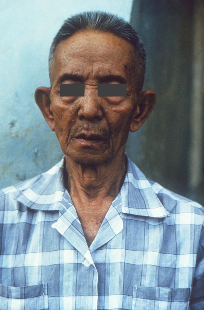 Lepromatous leprosy. Note few cutaneous facial nodules.Adapted from Public Health Image Library (PHIL), Centers for Disease Control and PreventionPublic Health Image Library (PHIL), Centers for Disease Control and Prevention[5]