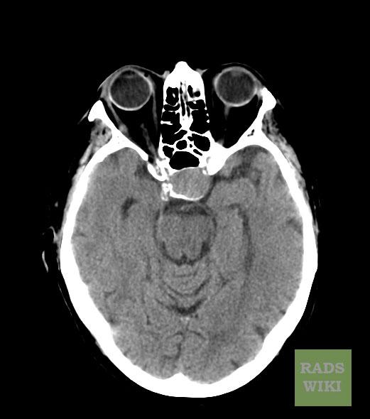 There is a well defined round isodense lesion noted in the pituitary fossa, the lesion is widening the sella.[4]