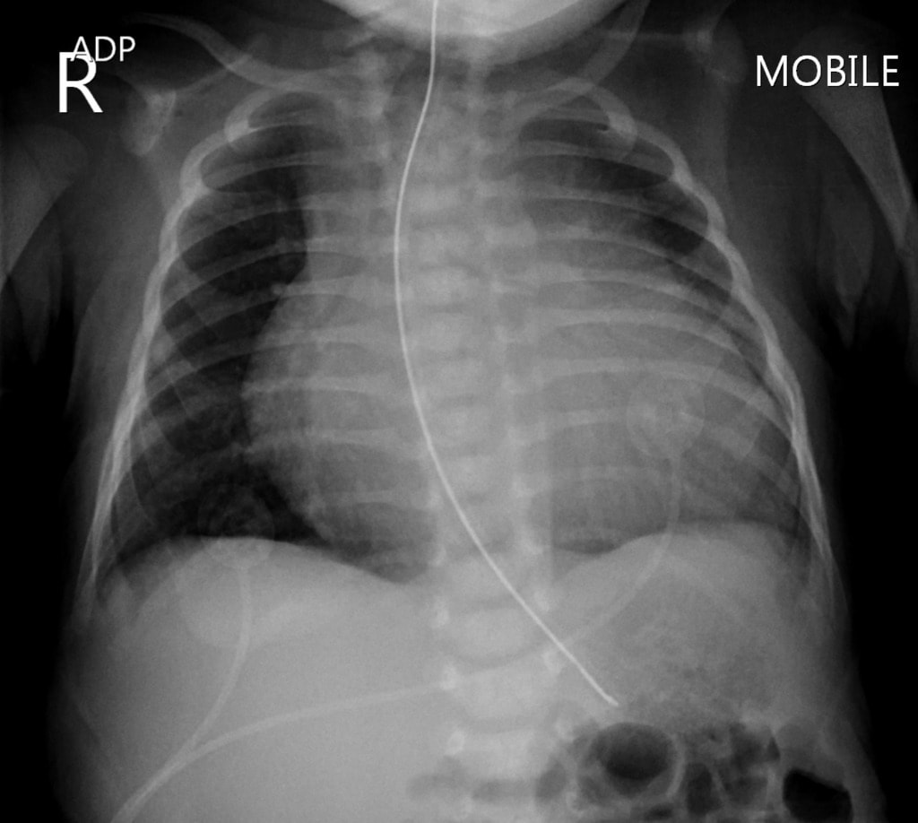 File:Pulmonary-atresia-with-intact-interventricular-septum.jpg