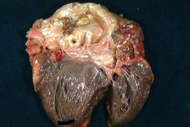 Dilated first portion of aortic arch with history of syphilitic vegetation on left coronary cusp that has eroded into central fibrous body like a valsalva aneurysm.