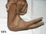 Ehlers-Danlos Syndrome Adapted from Dermatology Atlas