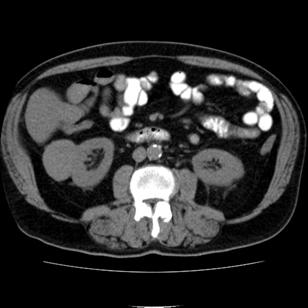 File:Hypovascular-renal-cell-carcinoma.jpg
