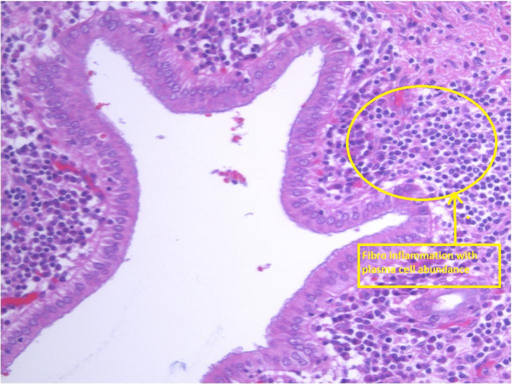 File:Mass-forming-autoimmune-pancreatitis (2).jpg