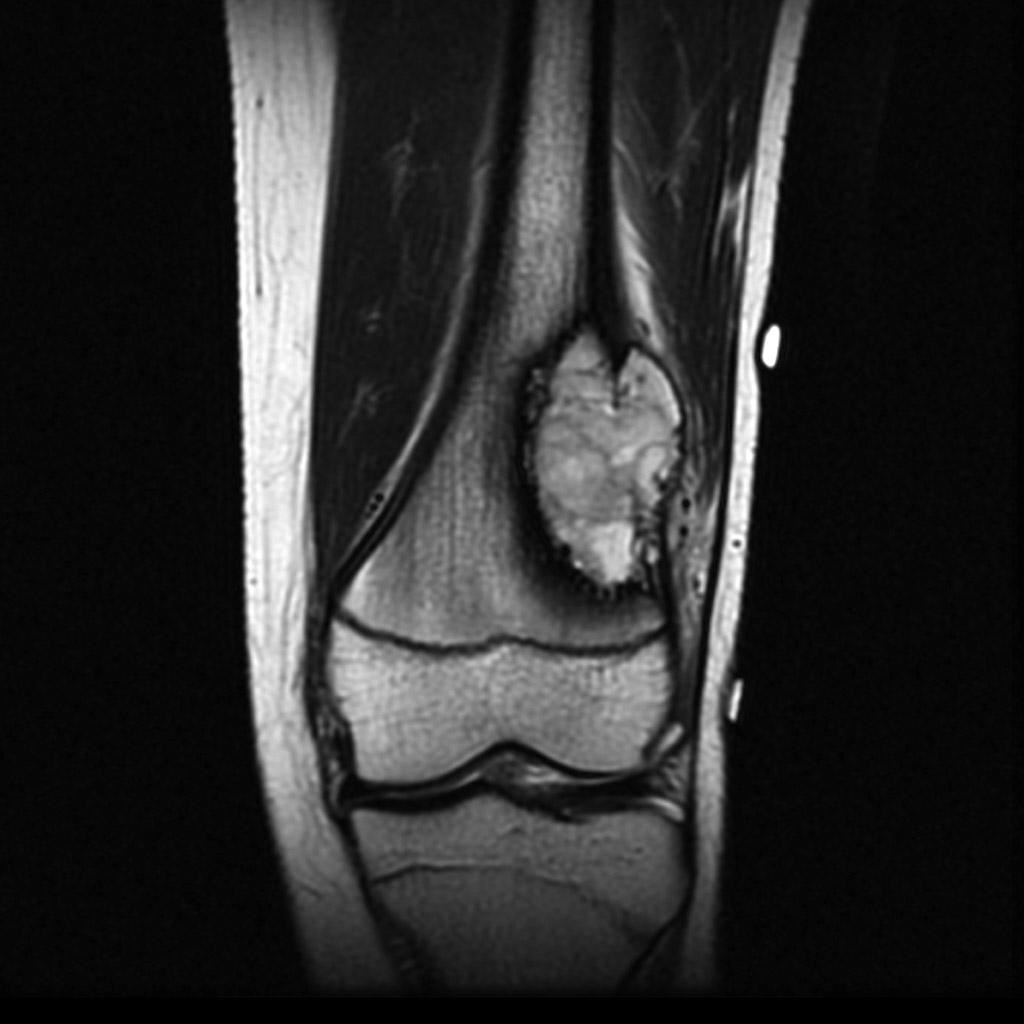 File:Osteosarcoma-distal-femur (1).jpg