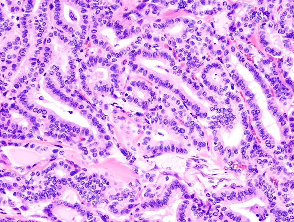File:Thyroid papillary carcinoma histopathology (2).jpg