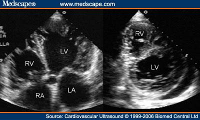 Transthoracic two-dimensional echocardiogram in apical four chamber and parasternal short axis at the level of both ventricles demonstrate dilatation, deep trabeculae and intertrabecular recesses in the inferior, lateral, anterior walls, middle and apical portions of the septum and apex of the left ventricle. [3]