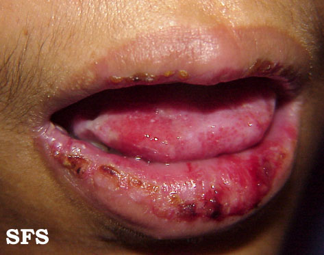Cicatricial pemphigoid. Adapted from Dermatology Atlas.[1]