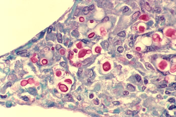 Cryptococcosis of lung in patient with AIDS. Mucicarmine stain. From Public Health Image Library (PHIL). [7]