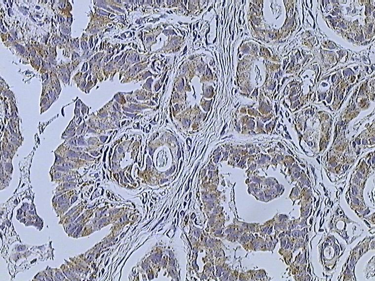 Breast cancer (Infiltrating ductal carcinoma of the breast) assayed with anti HER-2 (ErbB2) antibody