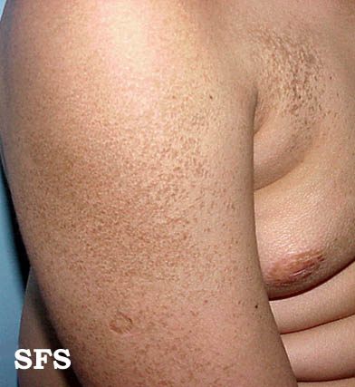 Icthyosis vulgaris. Adapted from Dermatology Atlas.[1]