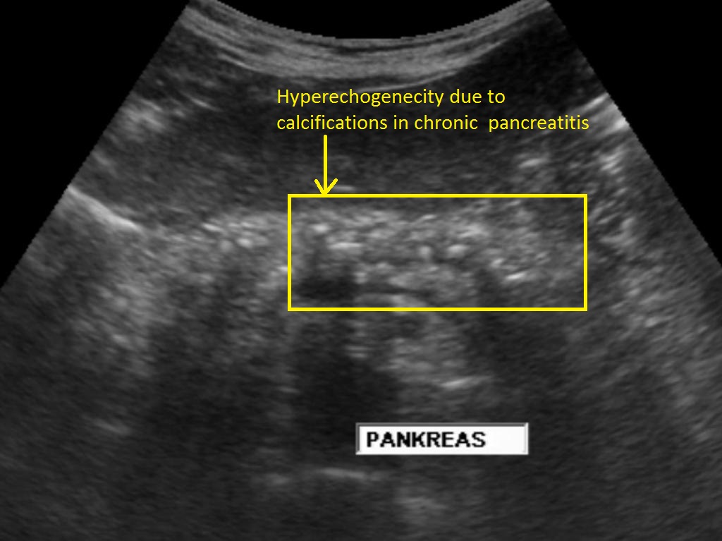 Chronic pancreatitis ultrasound - wikidoc