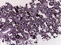 A smear showing psammomatous meningioma with numerous psammoma bodies