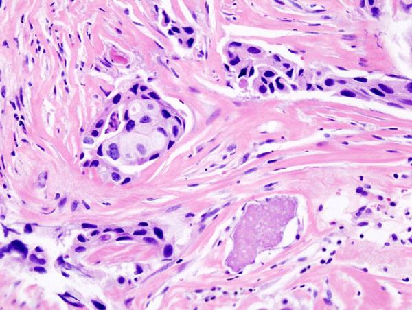 Histopathology of invasive ductal carcinoma of the breast representing a scirrhous growth. Core needle biopsy. Hematoxylin and eosin stain.