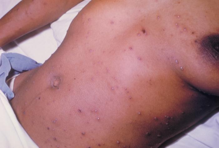 Chickenpox lesions on the skin of this patient's breasts, arms, and torso at day 6 of the illness. From Public Health Image Library (PHIL). [2]