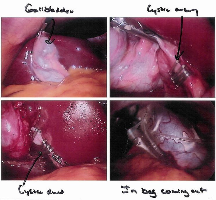 Cholecystectomy seen through a laparoscope