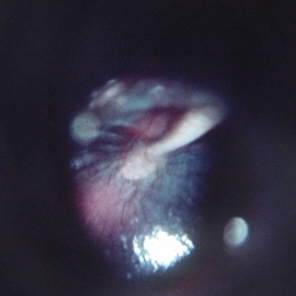 Hemotympanum (blood in the middle ear) causes a bluish discoloration of the drum [2].