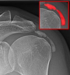 An X-ray image showing bursitis in the shoulder