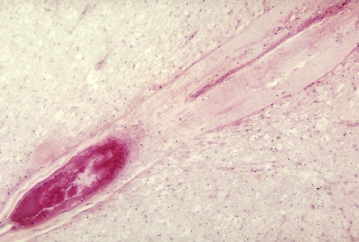 A photomicrograph of the lumbar spinal cord depicting an infarct due to Polio Type III surrounding the anterior spinal artery.Adapted from Public Health Image Library (PHIL), Centers for Disease Control and Prevention.[13]