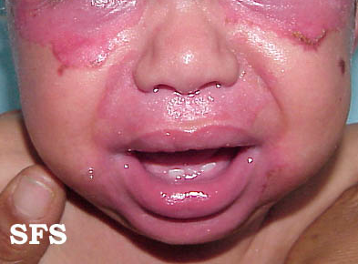 File:Acrodermatitis enteropathica 05.png