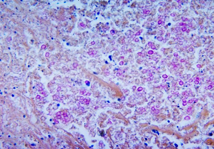 Micrograph depicts the histopathologic changes associated with cryptococcosis of the lung using Mucicarmine stain. From Public Health Image Library (PHIL). [8]