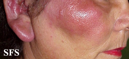 Erysipelas. Adapted from Dermatology Atlas.[7]