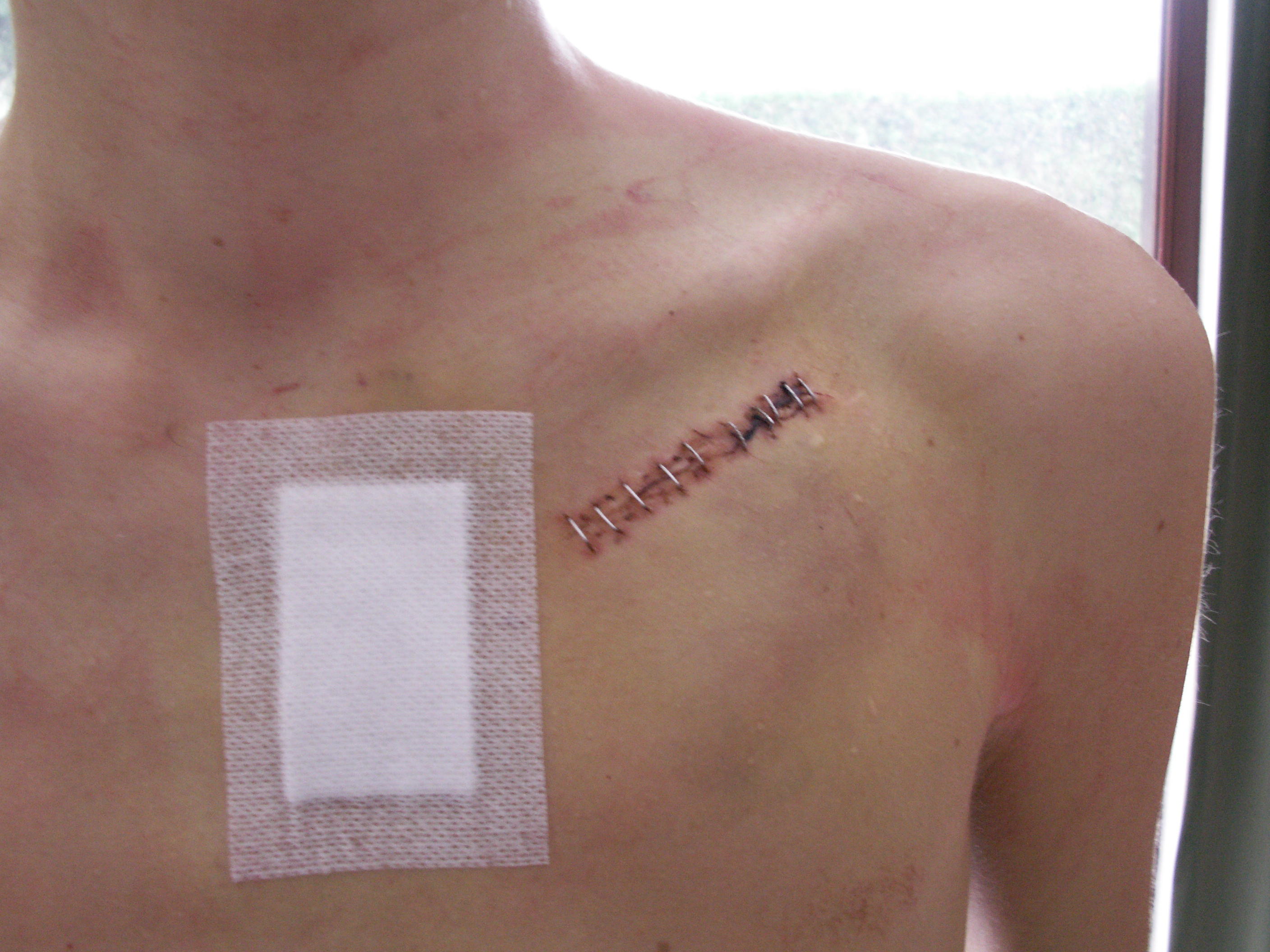 Pacemaker Wound