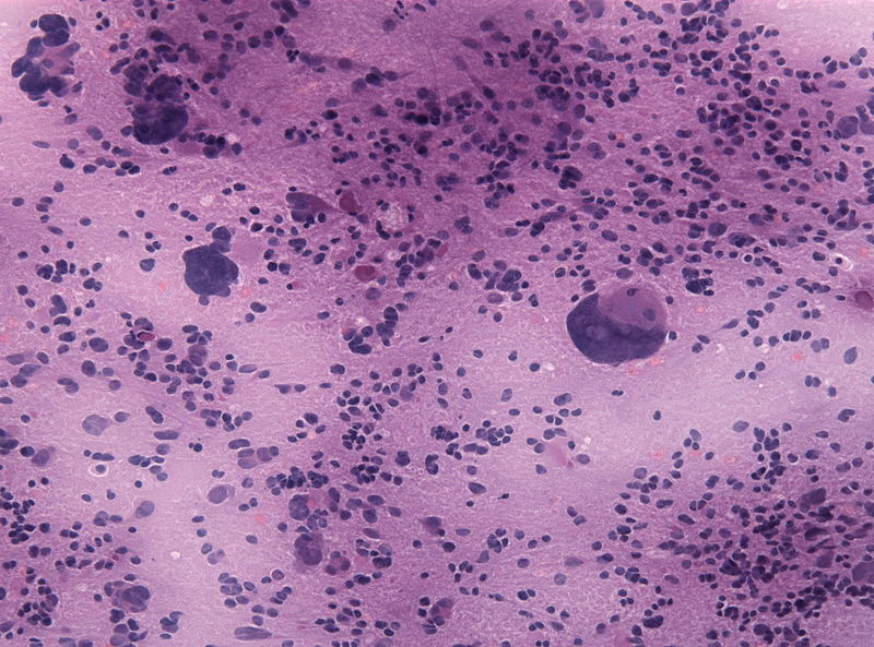File:Pineal parenchymal tumor with intermediate differentiation microscopic 1.jpg