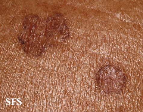Porokeratosis actinic. With permission from Dermatology Atlas.[5]