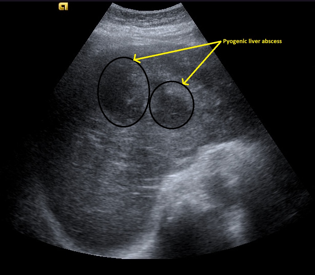 File:Pyogenic-hepatic-abscess-contrast-enhanced-ultrasound (3).jpg