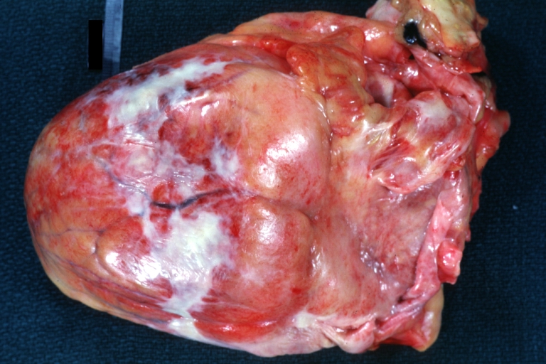 Heart: Soldiers Patch: Gross, natural color, large area of epicardial fibrosis over mid-portion of left ventricle.