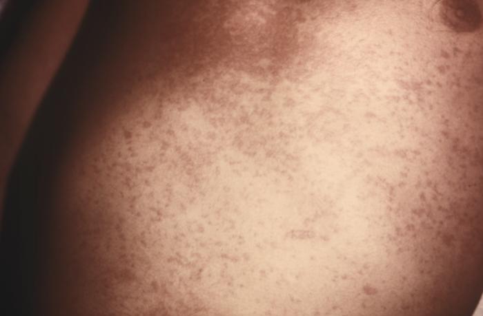 Right lateral surface of a patient’s right lower leg and foot with classic maculopapular rash of chickenpox. From Public Health Image Library (PHIL). [1]